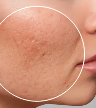 Akne-Subcision Behandlung