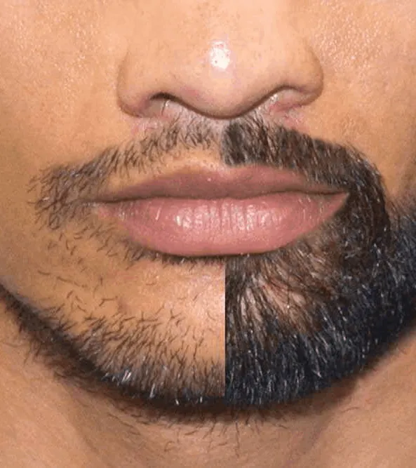 Barttransplantation