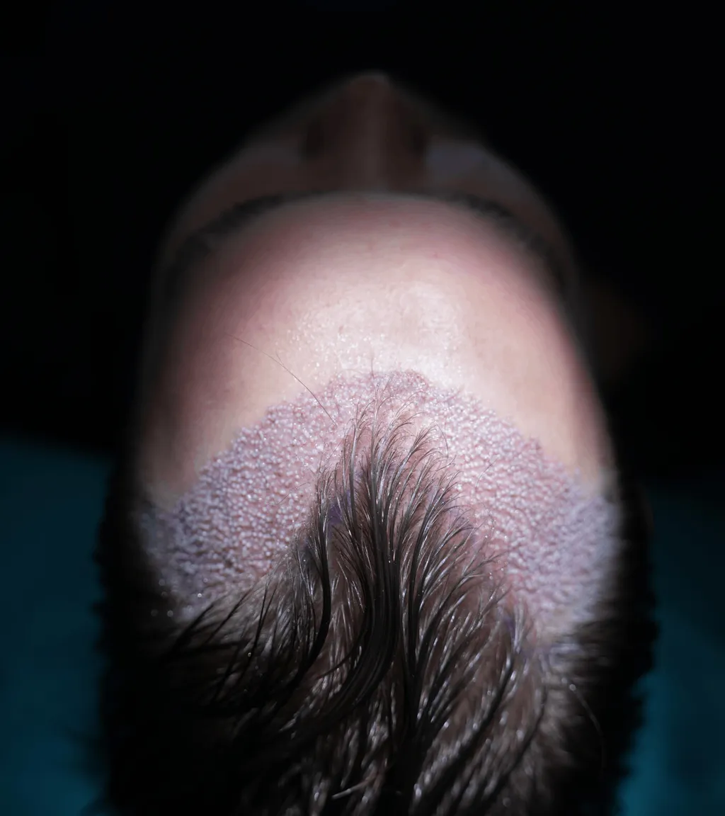 DHI FUE Haartransplantation