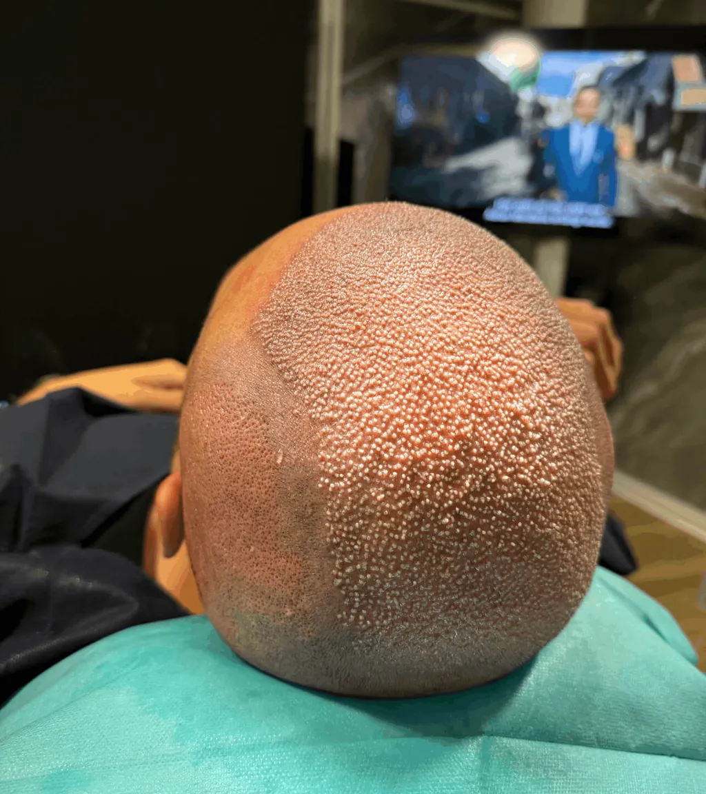 FUE Haartransplantation