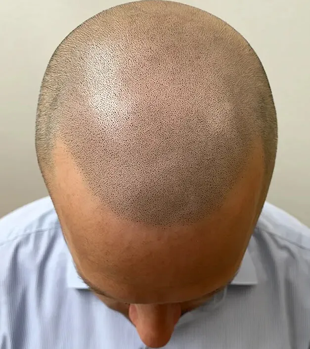Haarpigmentierung Behandlung