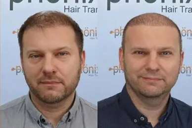 Haartransplantation Vorher Nachher – vollständige Wiederherstellung bei Norwood V–VI, Phönix Hair Trans Dortmund