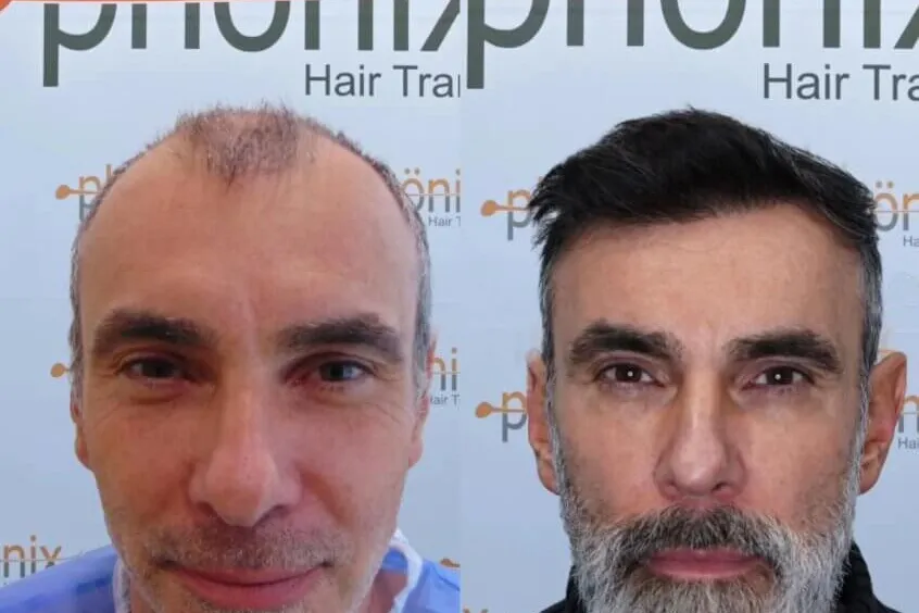 Haartransplantation Gesamtrekonstruktion Vorher Nachher – von vollständiger Glatze zu natürlichem Haar, Phönix Hair Trans Dortmund