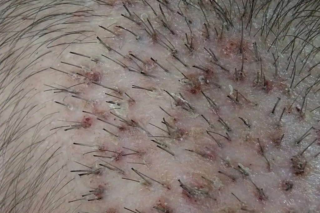 Schwellungen und Heilungsverlauf nach Haartransplantation – Nebenwirkungen und Nachsorge, Phönix Hair Trans Dortmund