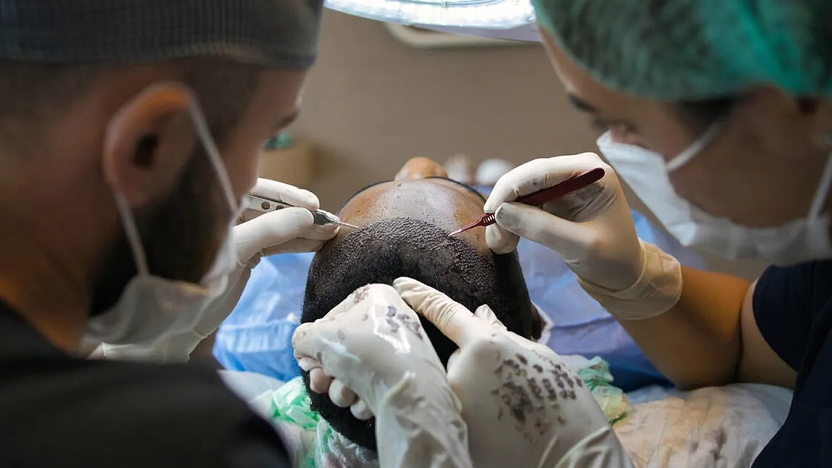 FUE Haartransplantation: Wissenschaftlich fundierter Leitfaden zu Ablauf & Sicherheit
