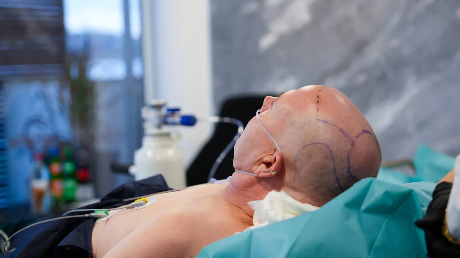 Sleep Deep: The Pain-Free Method – Leading Hair Transplantation in Europe