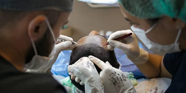 FUE Haartransplantation: Wissenschaftlich fundierter Leitfaden zu Ablauf & Sicherheit