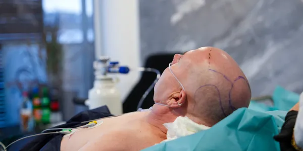 Sleep Deep: Die schmerzfreie Methode – Führende Haartransplantation in Europa