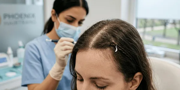 Haartransplantation bei Frauen: Hilfe bei dünner werdendem Haar und hoher Stirn