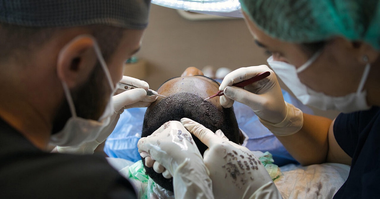 FUE Haartransplantation: Wissenschaftlich fundierter Leitfaden zu Ablauf & Sicherheit