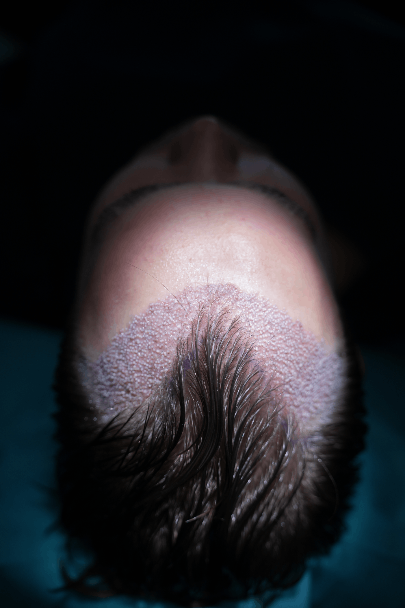 DHI FUE Haartransplantation