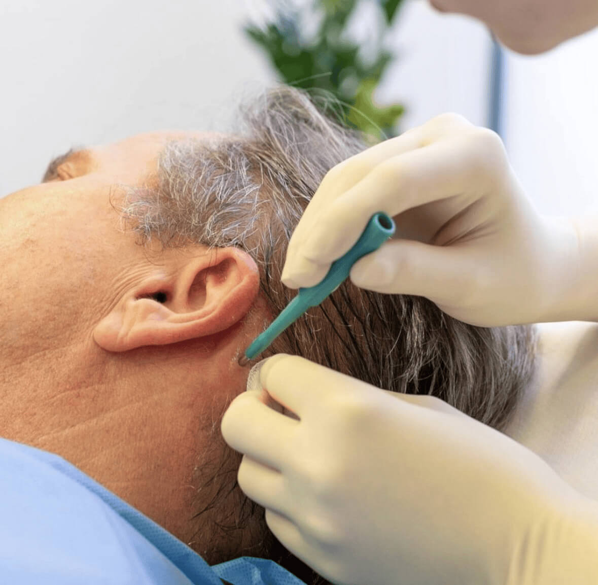 Fibroblast-Eigenstammzelltherapie