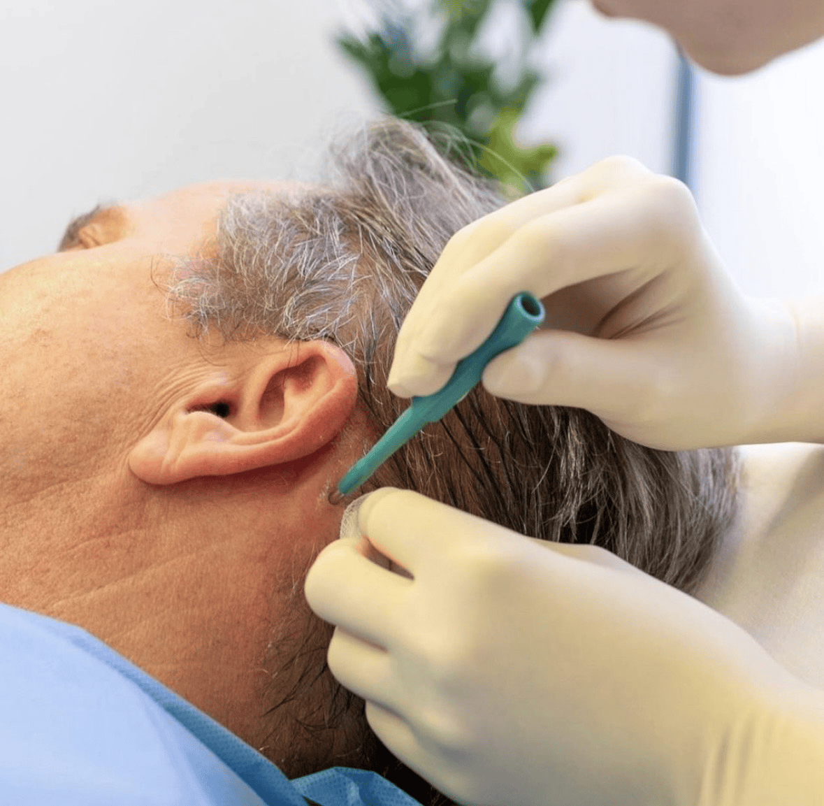 Fibroblast-Eigenstammzelltherapie