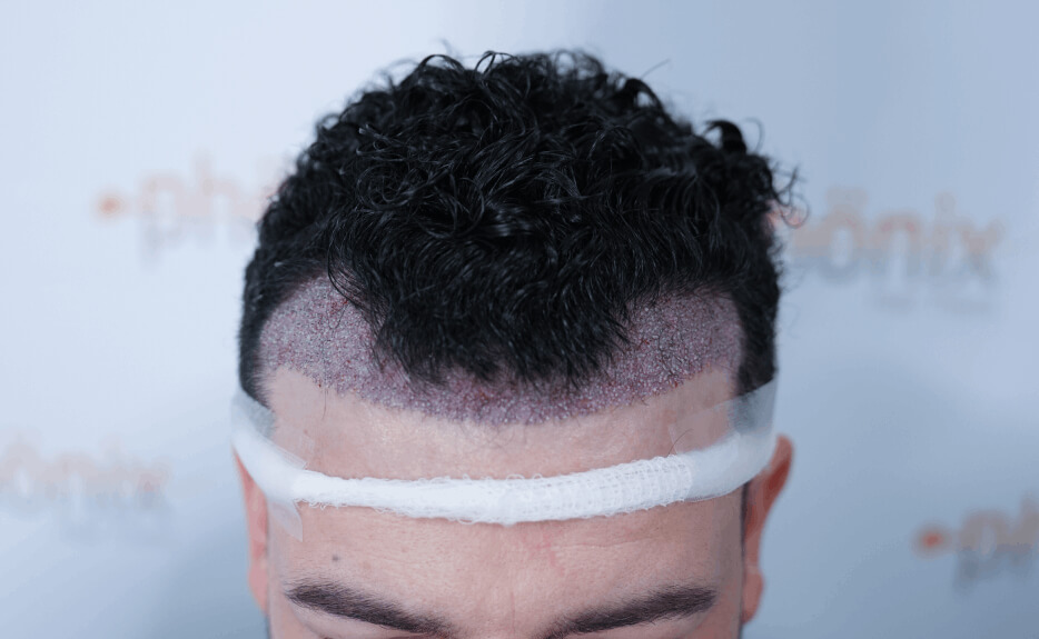Nachher Bild Haartransplantation