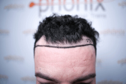 Vorher Bild Haartransplantation