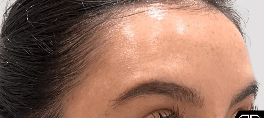 Nachher-Bild Hair Filler