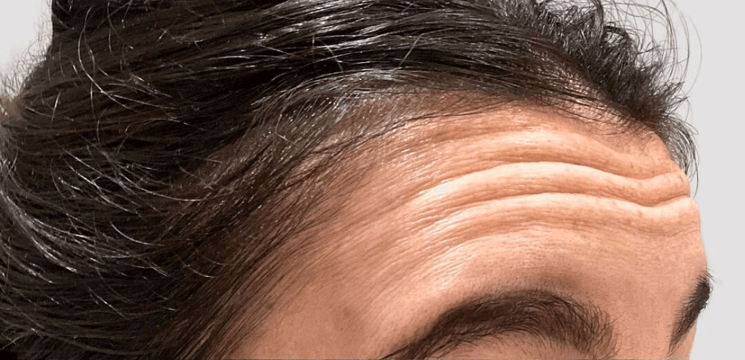 Vorher-Bild Hair Filler