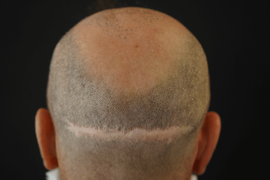 Vorher Narben-Haartransplantation 9 Monate