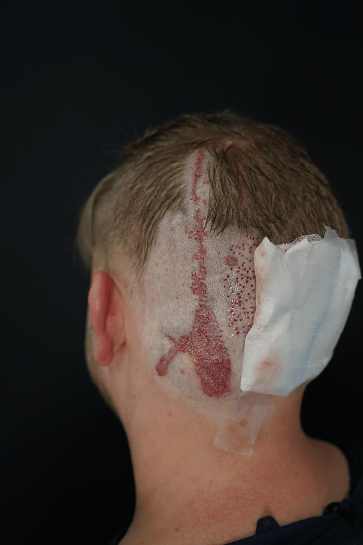 Nachher Narben-Haartransplantation 12 Monate