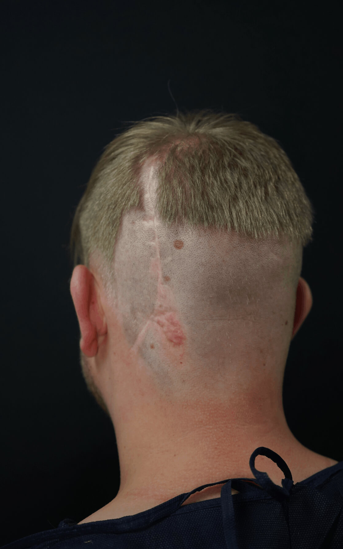 Vorher Narben-Haartransplantation 12 Monate