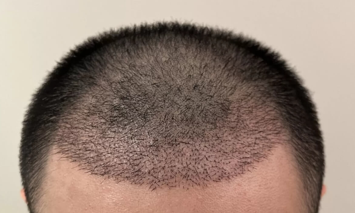Nachher Saphir FUE Haartransplantation 9 Monate