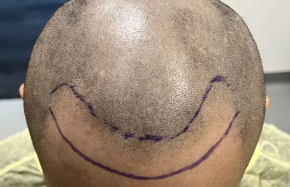 Vorher Saphir FUE Haartransplantation 9 Monate